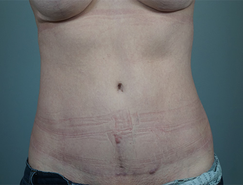 Case #732 After image