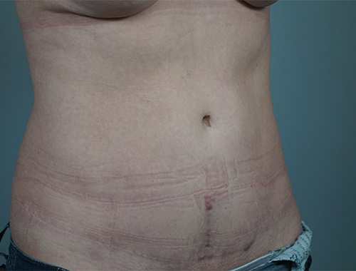 Case #732 After image