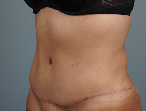 Case #733 After image