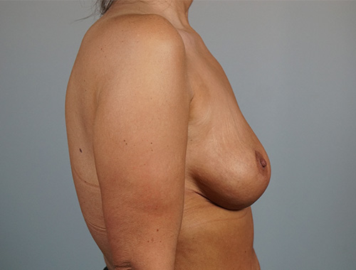 Case #730 After image