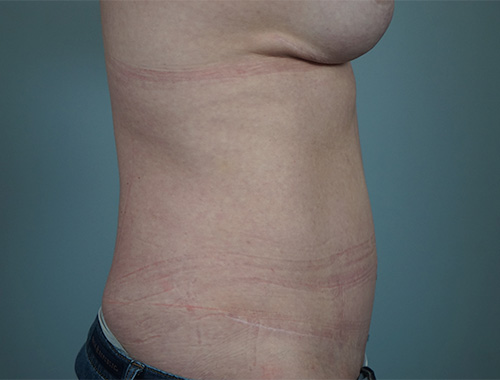 Case #732 After image