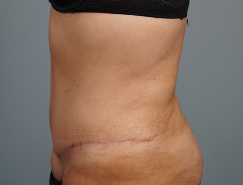 Case #733 After image