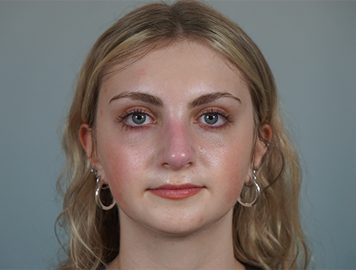 Case #736 After image