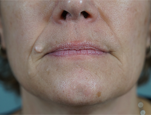 Case #740 Before image