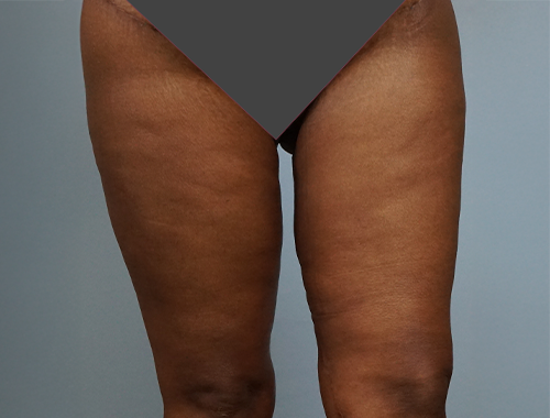 Case #739 After image