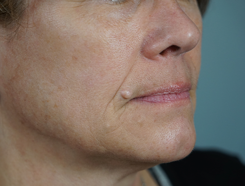 Case #740 Before image