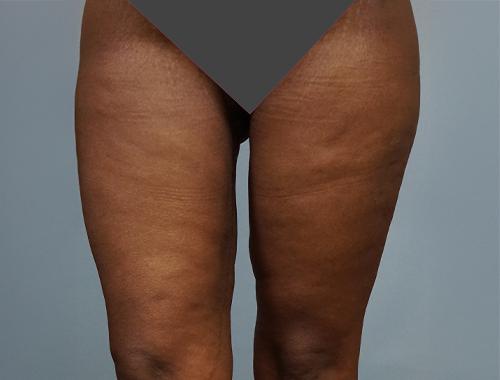 Case #739 After image