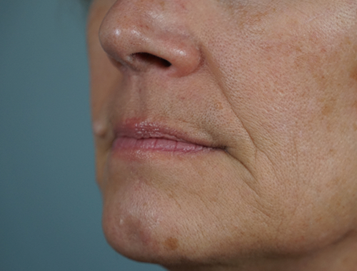 Case #740 Before image
