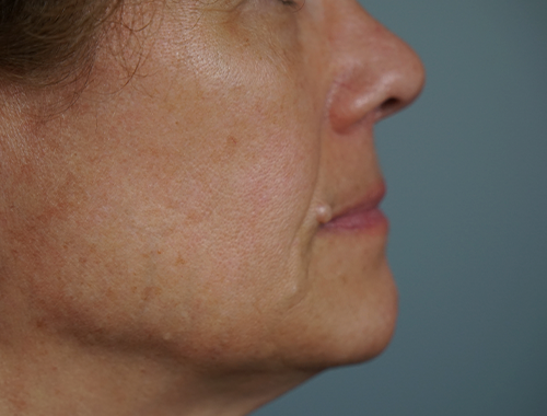 Case #740 Before image