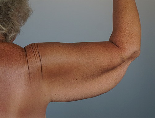 Case #746 Before image