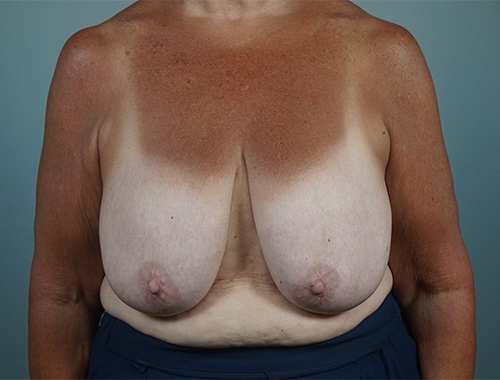 Case #747 Before image