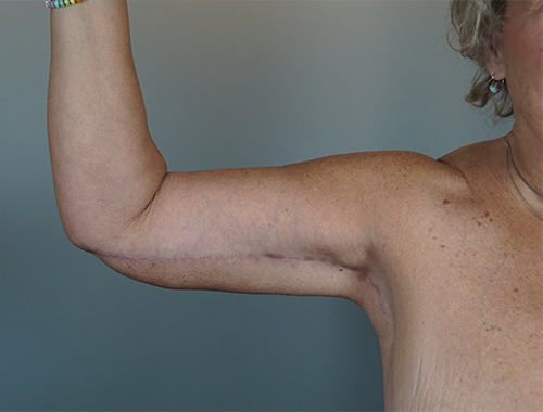 Case #746 After image