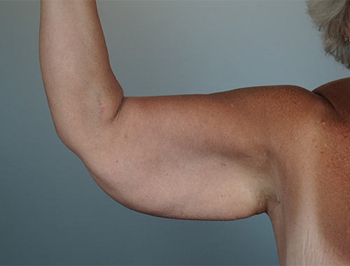 Case #746 Before image