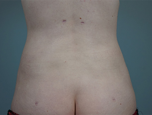 Case #757 After image