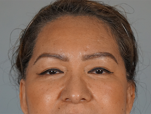 Case #753 After image