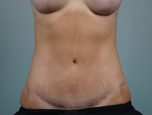 Case #754 After image
