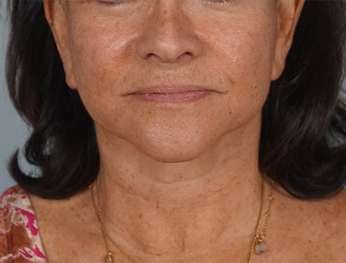 Case #762 After image