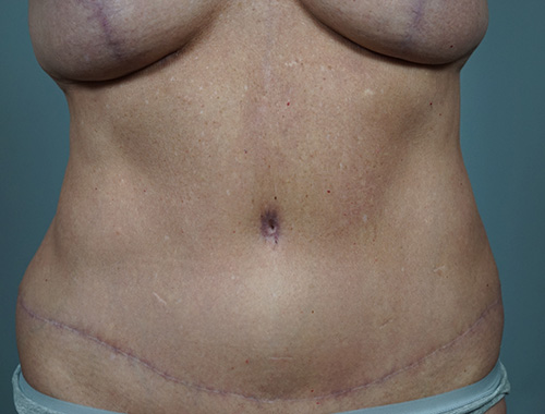 Case #749 After image