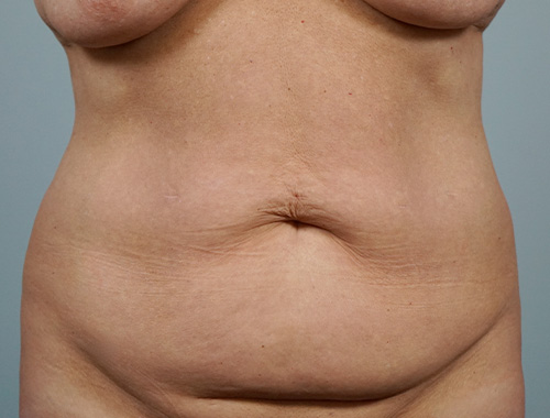 Case #749 Before image