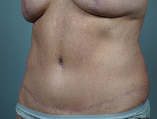 Case #749 After image