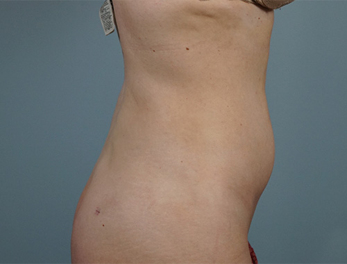 Case #757 After image