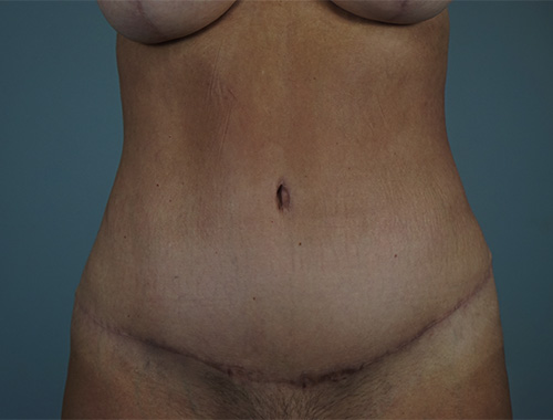 Case #765 After image