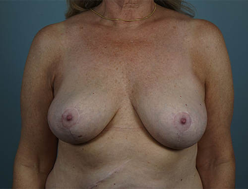 Case #766 After image