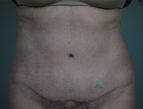 Case #764 After image