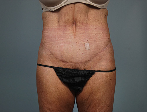 Case #771 After image